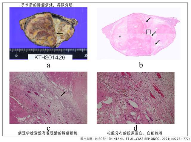 k药联合化疗治疗胰腺癌_贝伐单抗与K药联合治疗肝癌_肺癌新药贝伐单抗