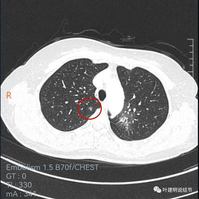 奥希替尼印度版多少钱_中国版奥希替尼_奥希替尼对三阴乳腺癌有帮助吗