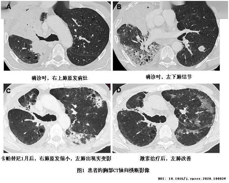 奥希替尼有效靶点_奥希替尼都有哪里产的_去哪买印度版奥希替尼