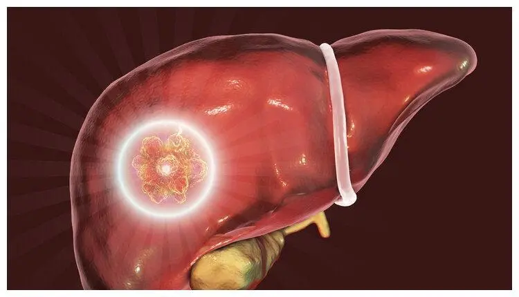 胆管细胞癌手术成功率_手术后肝细胞癌能吃索拉非尼_肝常规检查能查癌吗