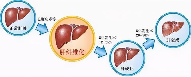 手术后肝细胞癌能吃索拉非尼_胆管细胞癌手术成功率_肝肉瘤样癌能治愈吗