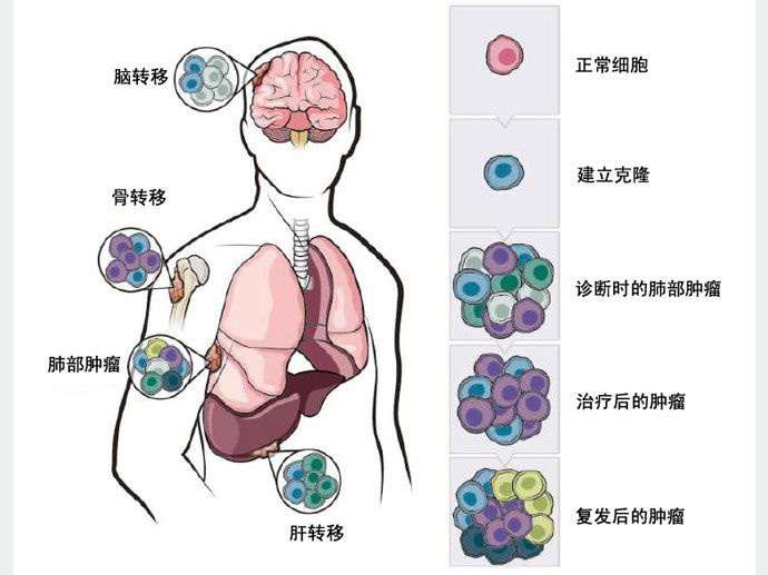 奥希替尼能治肾细胞癌转肺吗_肾透明细胞癌骨转移_肾透明细胞癌饮食