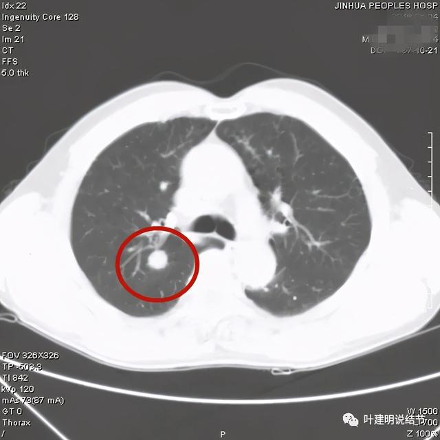 贝伐珠单抗治疗乳腺效果好不好_贝伐珠单抗赠药_贝伐珠单抗价格