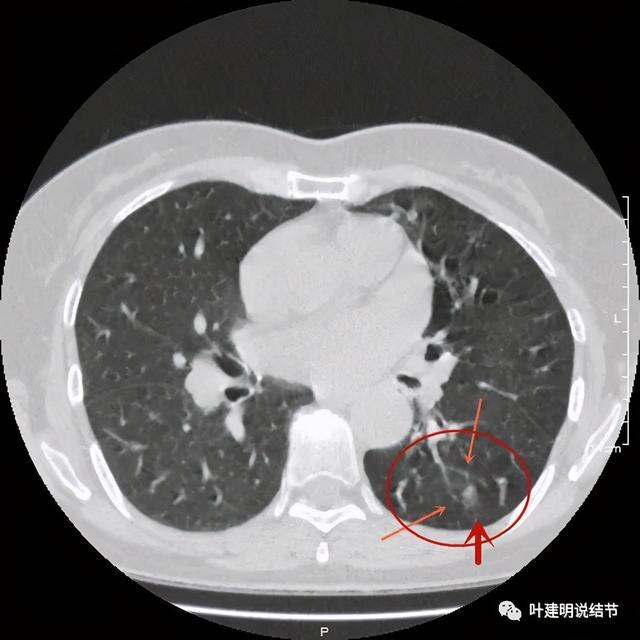 贝伐珠单抗赠药_贝伐珠单抗价格_贝伐珠单抗治疗乳腺效果好不好