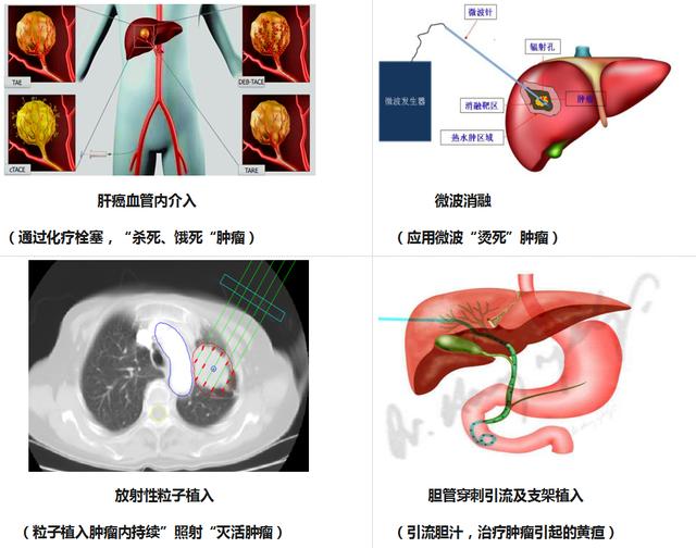 索拉非尼 舒尼替尼_肝癌介入吃索拉非尼_索拉非尼 肝癌有效率