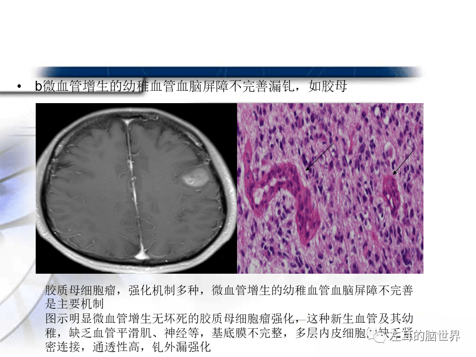 贝伐珠单抗_贝伐单抗和贝伐珠单抗_贝伐单抗对脑转移效果