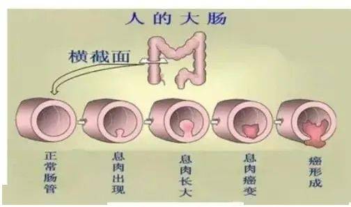 贝伐单抗印度版_贝伐珠单抗靶向是啥_贝伐单抗腹胀心慌