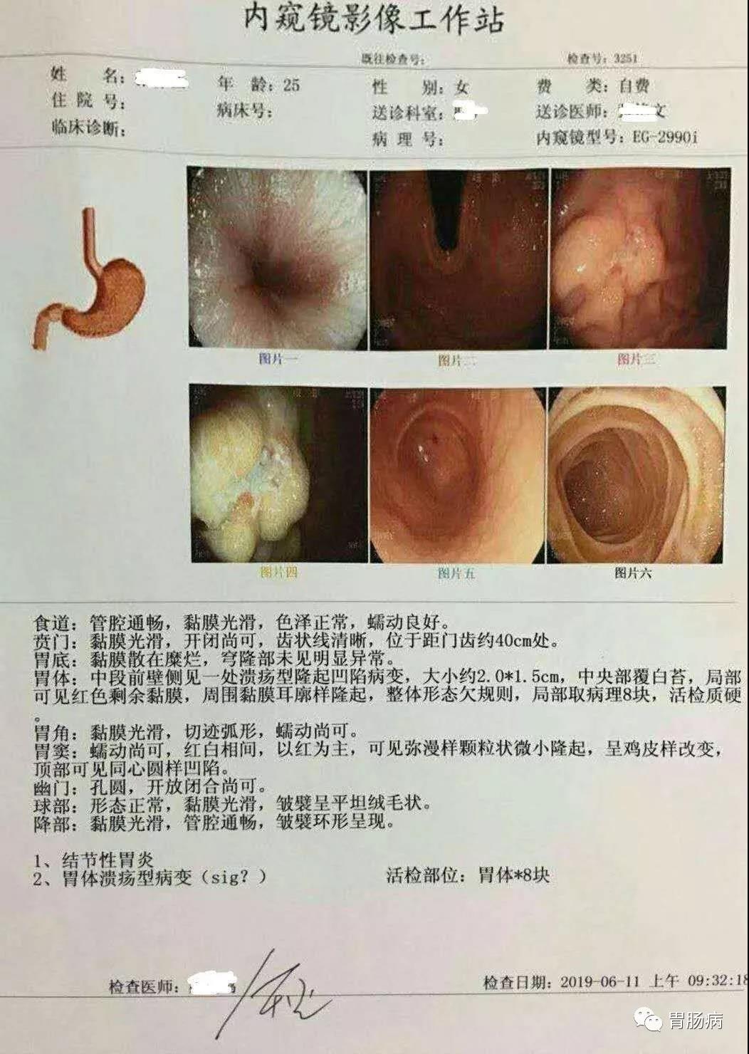 一在越来越多国家胃癌变成罕见病可期