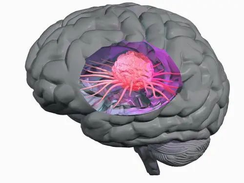 贝伐珠单抗治疗肺腺癌_贝伐单抗和贝伐珠单抗_贝伐珠单抗治疗肺癌脑转移效果