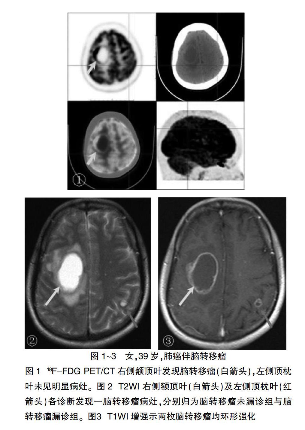 贝伐珠单抗4个月后赠药_贝伐单抗 肺癌_肺癌用贝伐珠单抗