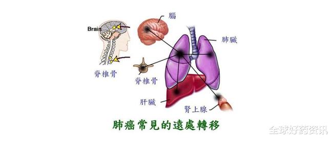 奥希替尼脑转移耐药时间_印度9291奥希替尼图片_甲磺酸奥希替尼片