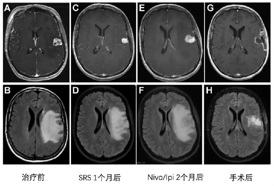 azd 9291 奥希替尼_奥希替尼9291药品_奥希替尼9291使用说明