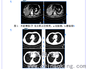 肝癌吃索拉非尼的效果_索拉非尼肝癌延长时间_酒精性肝癌与索拉非尼