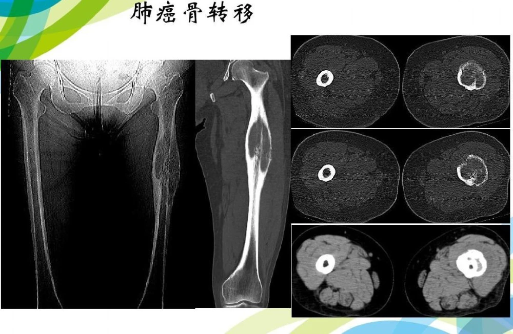 甲磺酸奥希替尼片_奥希替尼对骨转的作用_进口奥希替尼