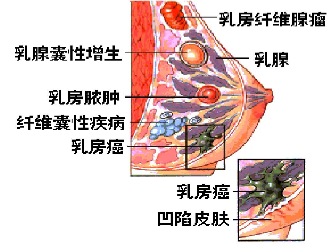 贝伐珠单抗对乳腺癌_贝伐珠单抗是化疗吗_贝伐珠单抗