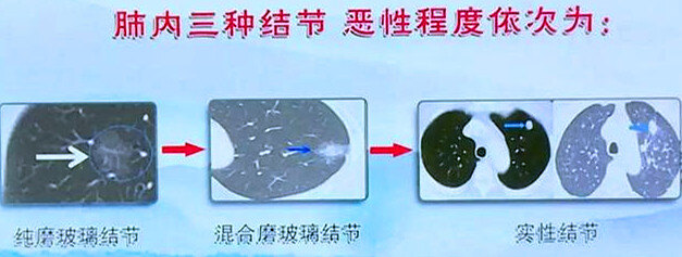 奥希替尼多少钱一盒_奥希替尼试验效果怎么样_奥斯替尼和奥希替尼