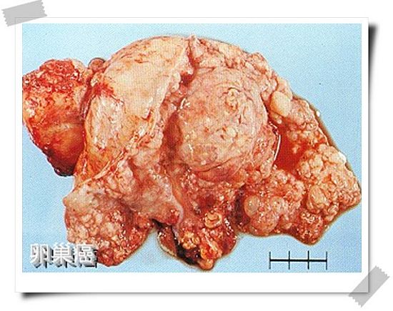 临床ii期_奥希替尼的II期临床研究_奥希替尼印度版白盒