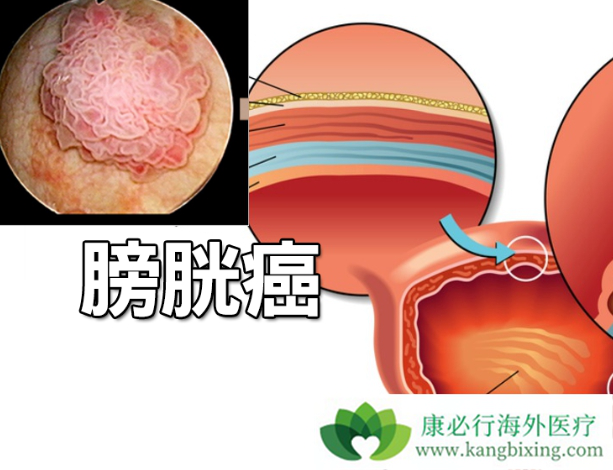 使用化疗药物的注意事项_吉非替尼可以和化疗一起使用吗_尼妥珠单抗联合化疗治疗胰腺癌的临床研究