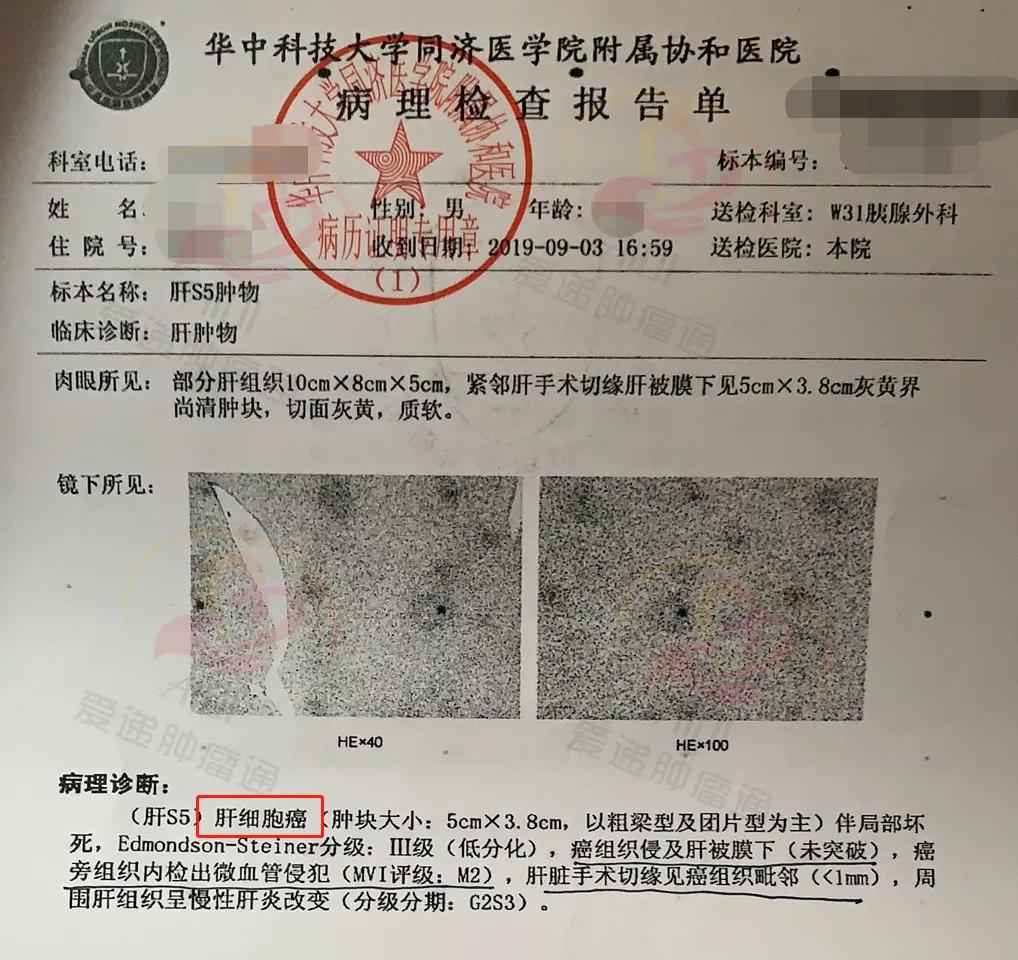 索拉非尼治疗宫颈癌_宫颈管癌早期 该怎么治疗_索拉非尼