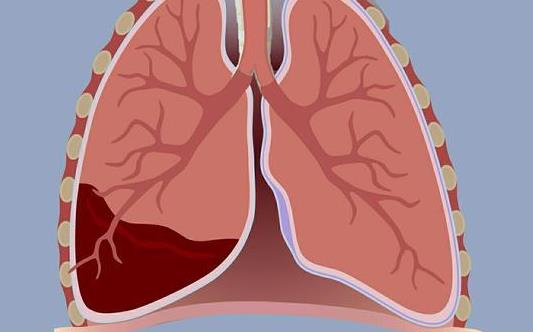 目的观察贝伐单抗治疗肺癌患者恶性胸腔积液的疗效及其影响