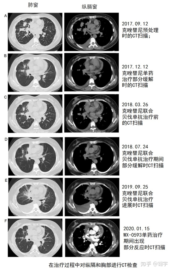 中国版奥希替尼_阿美替尼和奥希替尼疗效对比_奥希替尼9291哪里买