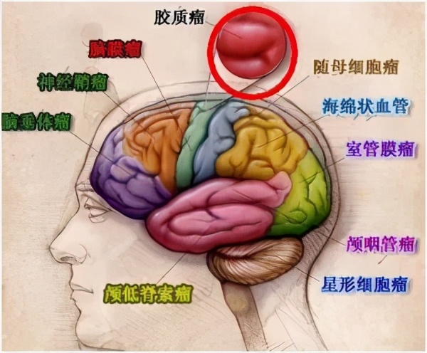 贝伐单抗治疗脑胶质瘤癌症_贝伐珠单抗治疗肺腺癌_贝伐珠单抗价格