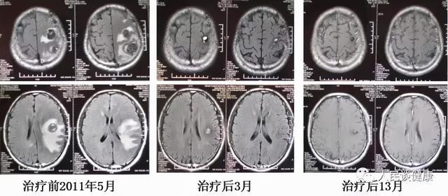 肺癌晚期还有救吗_肺癌肺癌晚期死前7天症状_吉非替尼对肺癌晚期