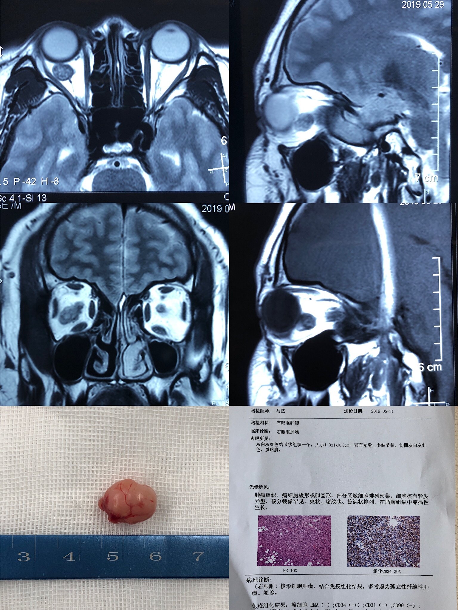 贝伐单抗和贝伐珠单抗_尼妥珠单抗联合化疗_nsclc联合贝伐单抗化疗