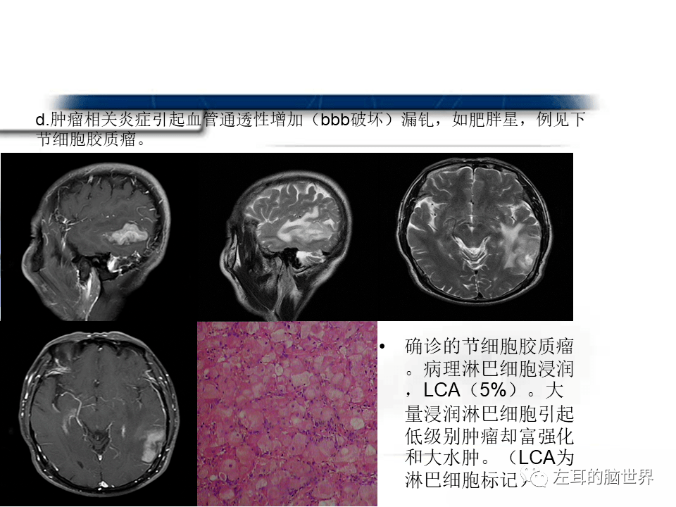 腹腔镜术后贝伐珠单抗_贝伐珠单抗是化疗药吗_贝伐珠单抗 耐药性