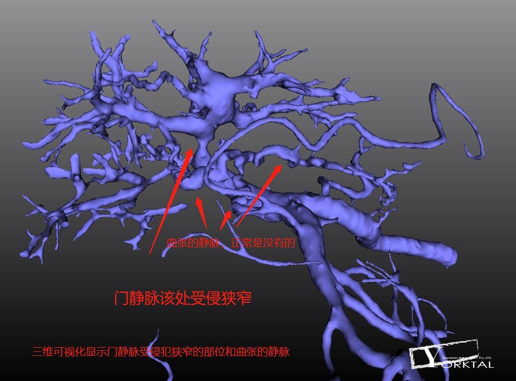 贝伐珠单抗 耐药性_贝伐珠单抗好不好_贝伐珠单抗价格