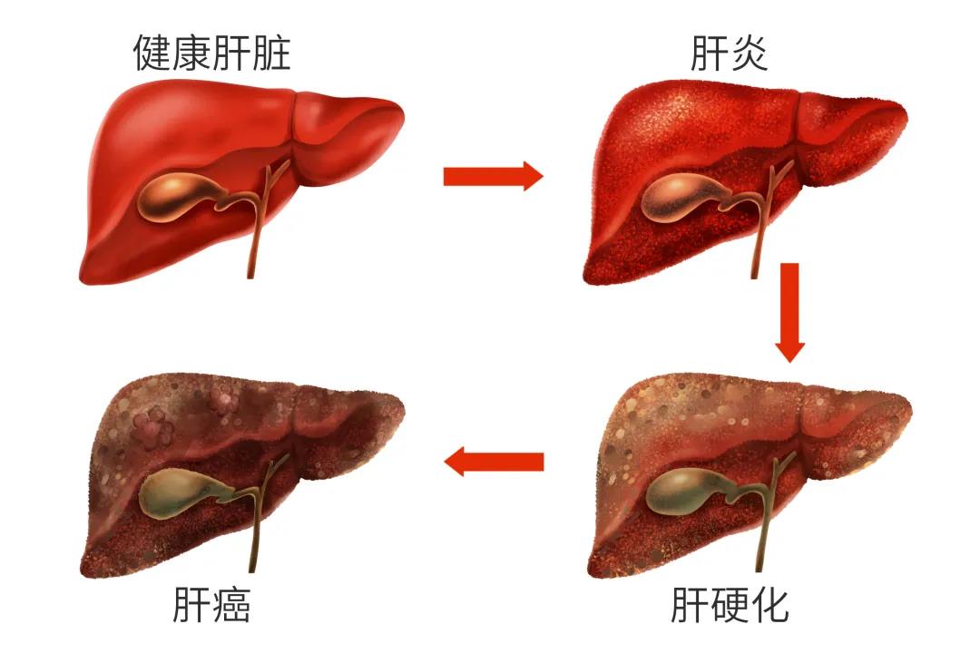 贝伐珠单抗的副作用_贝伐珠单抗与免疫_贝伐珠单抗治疗肺腺癌