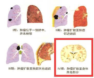 贝伐珠单抗赠药_结肠癌晚期 贝伐珠单抗_贝伐珠单抗一直用