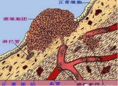 安淮汀.贝伐珠单抗_贝伐珠单抗是化疗药吗_结肠癌晚期 贝伐珠单抗