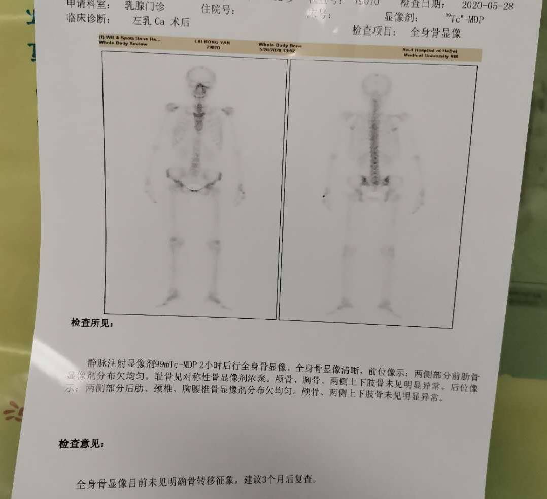 贝伐珠单抗最新价格_贝伐珠单抗脑转移脑水肿剂量_贝伐珠单抗治疗肺腺癌