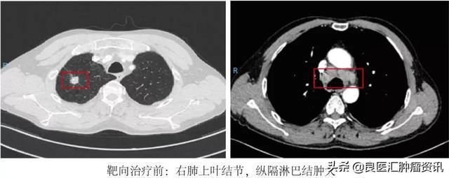 贝伐珠单抗价格_紫杉醇脂质体联合贝伐单抗_贝伐珠单抗靶向是啥