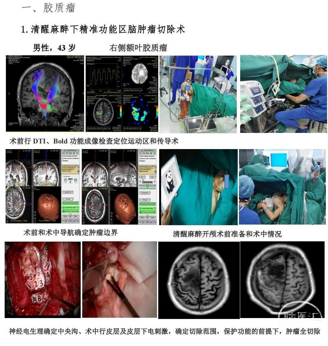 贝伐珠单抗脑胶质瘤_贝伐珠单抗最新价格_贝伐珠单抗赠药