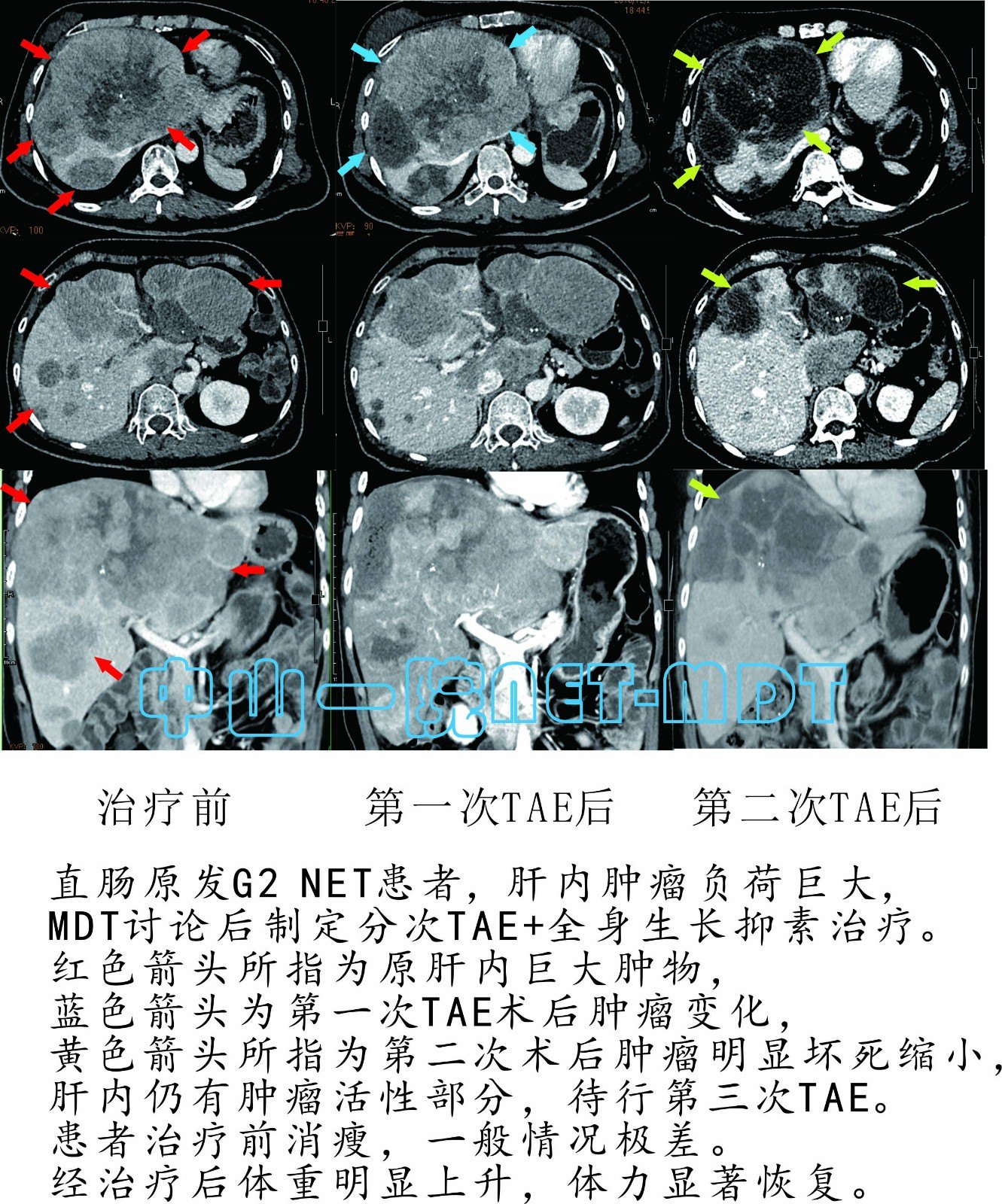 贝伐珠单抗治疗结肠癌肝转移_贝伐珠单抗说明书_贝伐珠单抗