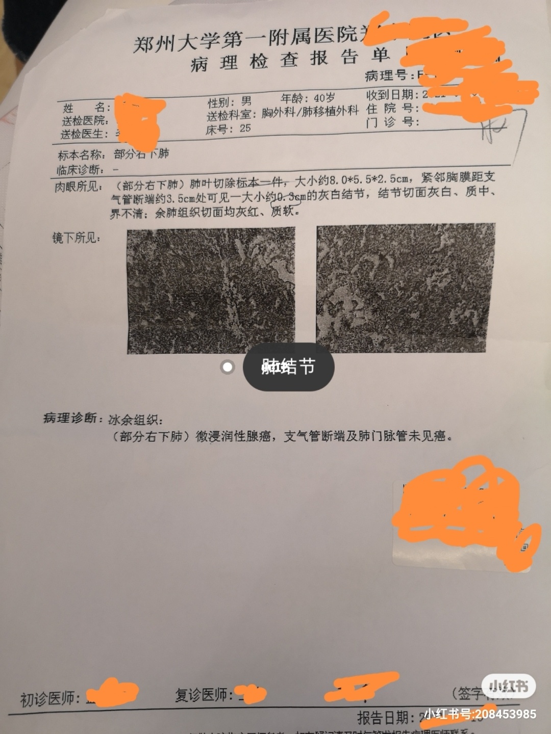 肺癌奥希替尼治疗生存期多久_azd9291奥希替尼_奥斯替尼和奥希替尼