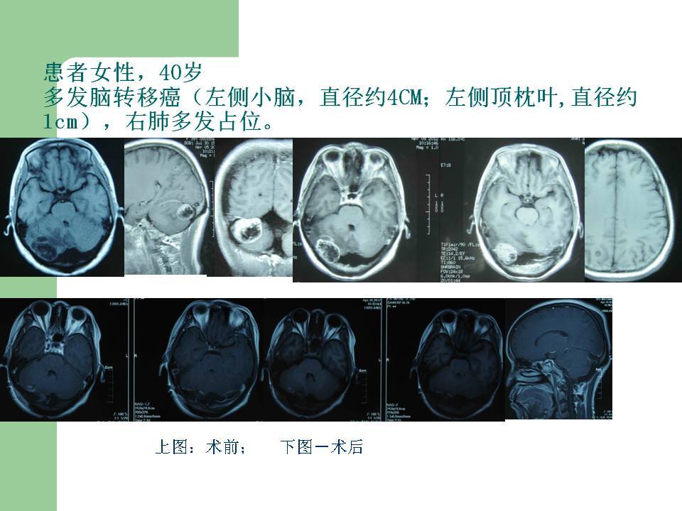 中国版奥希替尼_阿斯利康 奥希替尼_奥希替尼神奇的疗效