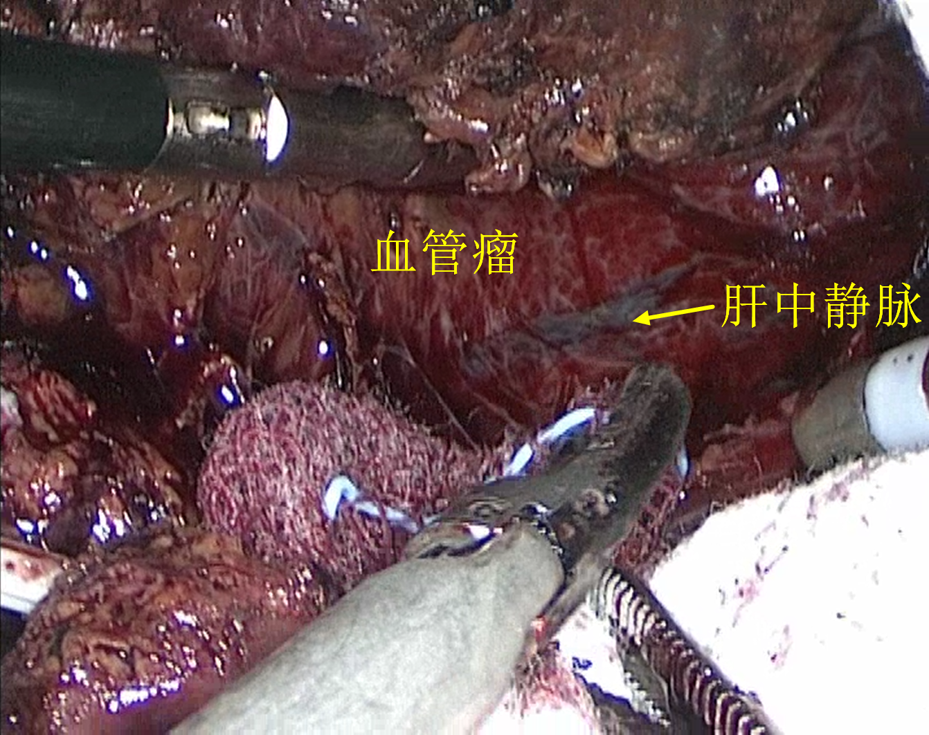 贝伐珠单抗可以报销吗_贝伐珠单抗可以治愈结肠癌吗_贝伐珠单抗靶向是啥