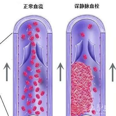 贝伐单抗是靶向药吗_输贝伐单抗容易引起静脉血栓吗_贝伐单抗多久有耐药性