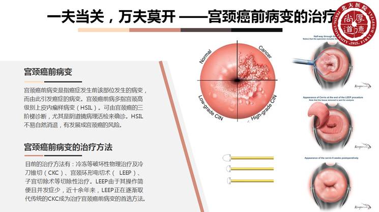 贝伐珠单抗注射液_贝伐珠单抗多少钱一支_宫颈癌复发能用贝伐单抗吗