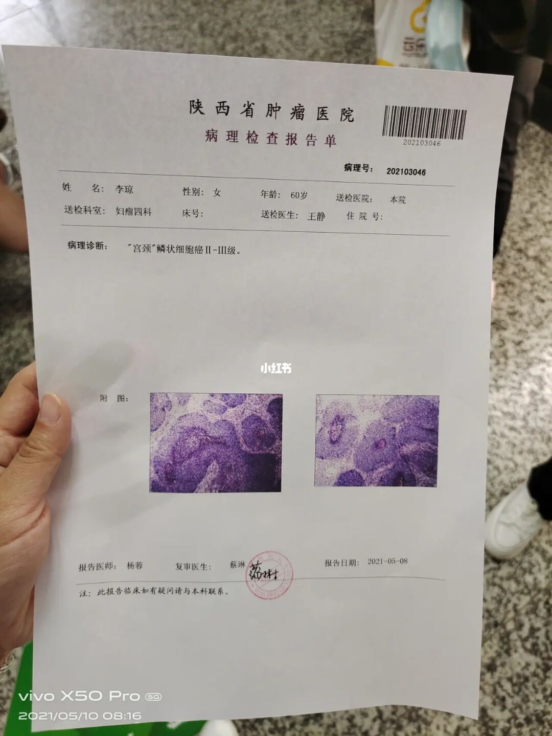 贝伐珠单抗注射液_宫颈癌复发能用贝伐单抗吗_贝伐珠单抗多少钱一支