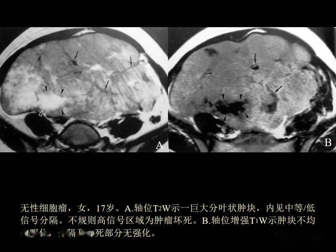 贝伐单抗耐药性_贝伐珠单抗是化疗药吗_用贝伐单抗腹腔注射消腹水