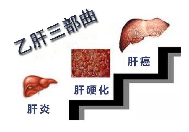 索拉非尼吃好了肝癌_索拉非尼能治转移肝癌吗_肝癌能转移胰腺吗