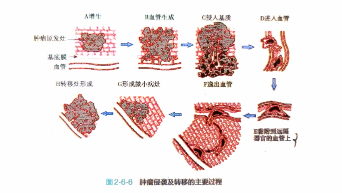 乳腺粘液癌怎么治疗_香港买奥希替尼多少钱_奥希替尼可以治疗乳腺癌