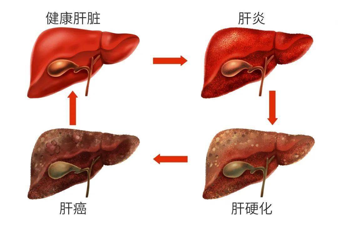 贝伐珠单抗与pd1肝癌_贝伐珠单抗治疗肺腺癌_贝伐珠单抗