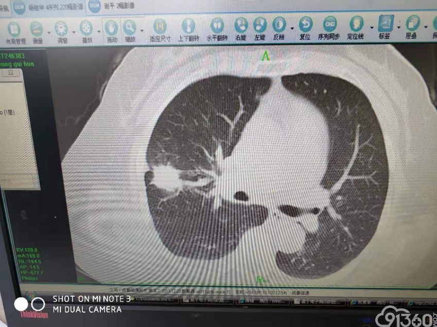 癌症前会出3种身体信号6_癌症前期的18种预兆_吉非替尼针对哪种癌症