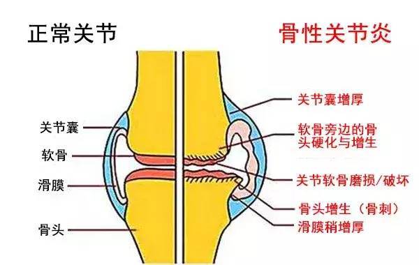 苹果酸舒尼替尼有替代药吗_吉非替尼对骨转移有作用吗_肺癌转移骨