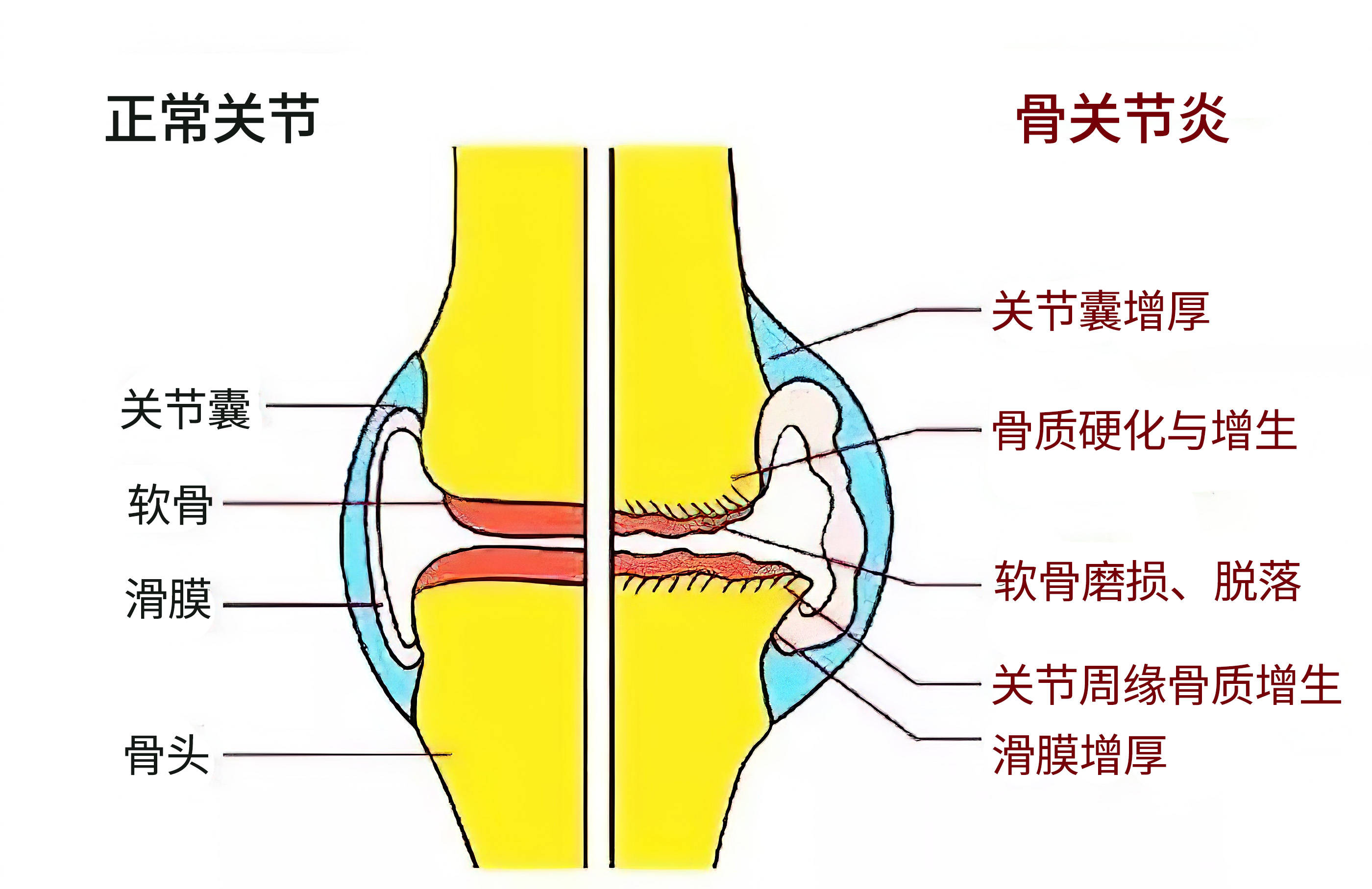 肺癌转移骨_吉非替尼对骨转移有作用吗_苹果酸舒尼替尼有替代药吗